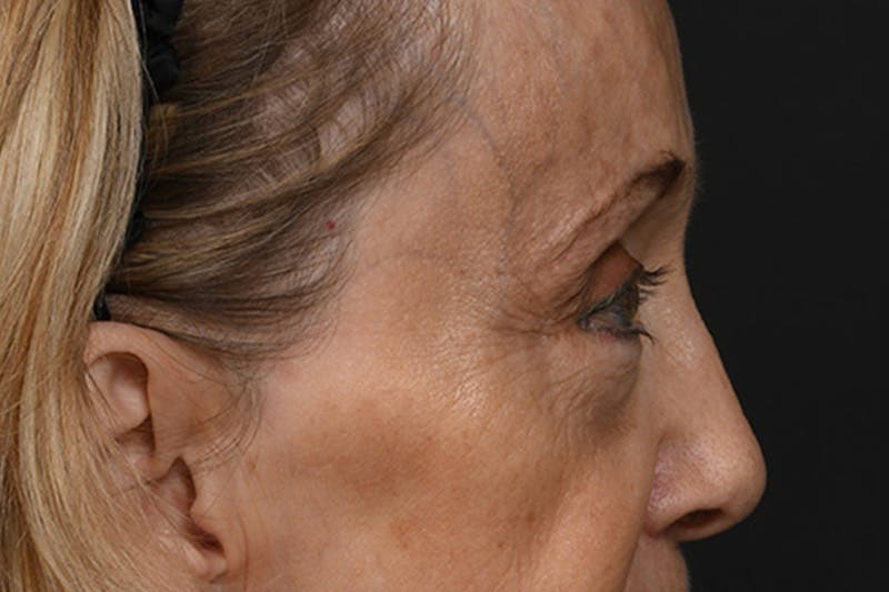 Blepharoplasty Before & After Gallery - Patient 397722 - Image 5