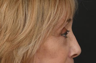 Blepharoplasty Before & After Gallery - Patient 397722 - Image 6