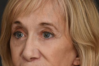 Blepharoplasty Before & After Gallery - Patient 397722 - Image 8