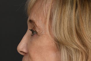 Blepharoplasty Before & After Gallery - Patient 397722 - Image 10