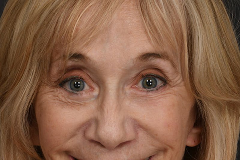 Blepharoplasty Before & After Gallery - Patient 397722 - Image 12