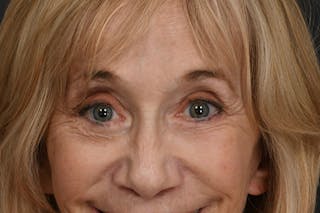 Blepharoplasty Before & After Gallery - Patient 397722 - Image 12