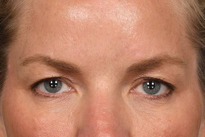 Blepharoplasty Before & After Gallery - Patient 426841 - Image 1