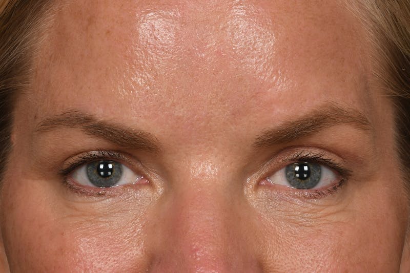 Blepharoplasty Before & After Gallery - Patient 426841 - Image 2