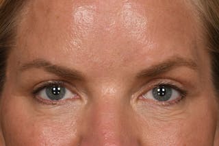 Blepharoplasty Before & After Gallery - Patient 426841 - Image 2