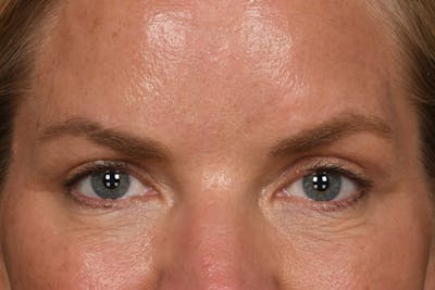 Blepharoplasty Before & After Gallery - Patient 426841 - Image 2