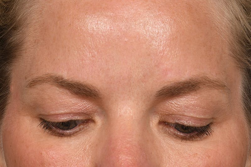 Blepharoplasty Before & After Gallery - Patient 426841 - Image 3