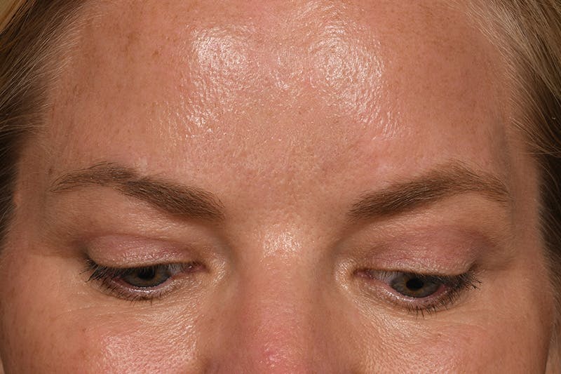 Blepharoplasty Before & After Gallery - Patient 426841 - Image 4