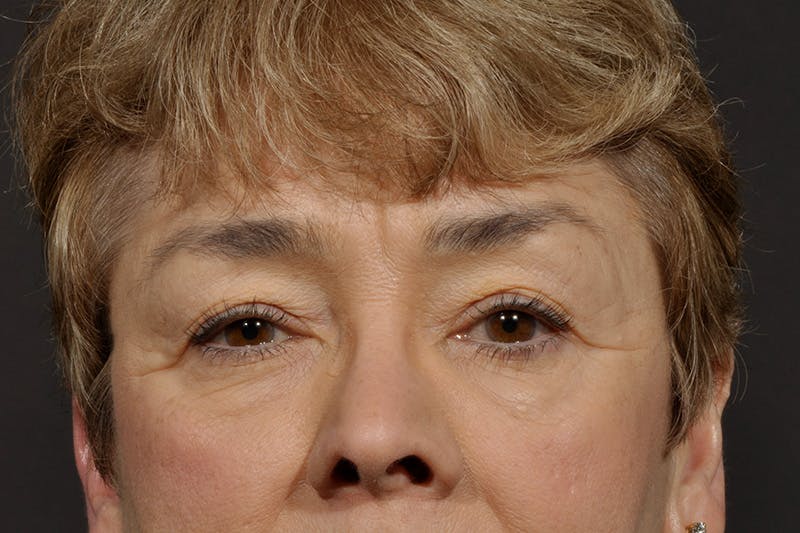Blepharoplasty Before & After Gallery - Patient 557948 - Image 1