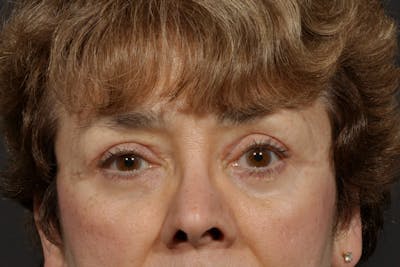 Blepharoplasty Before & After Gallery - Patient 557948 - Image 2