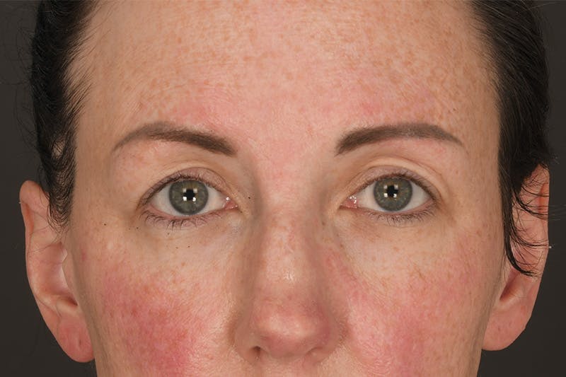 Blepharoplasty Before & After Gallery - Patient 383160 - Image 1