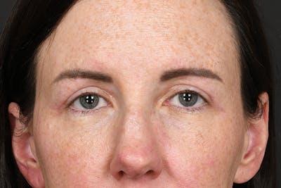 Blepharoplasty Before & After Gallery - Patient 383160 - Image 2