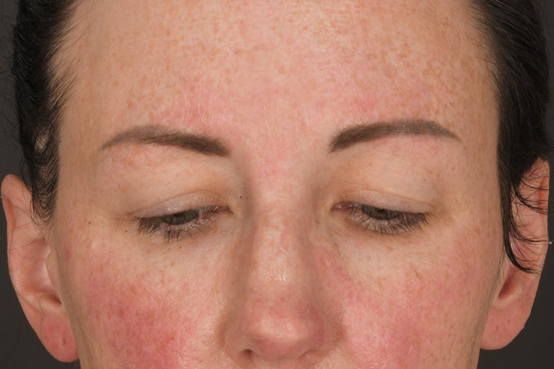 Blepharoplasty Before & After Gallery - Patient 383160 - Image 3