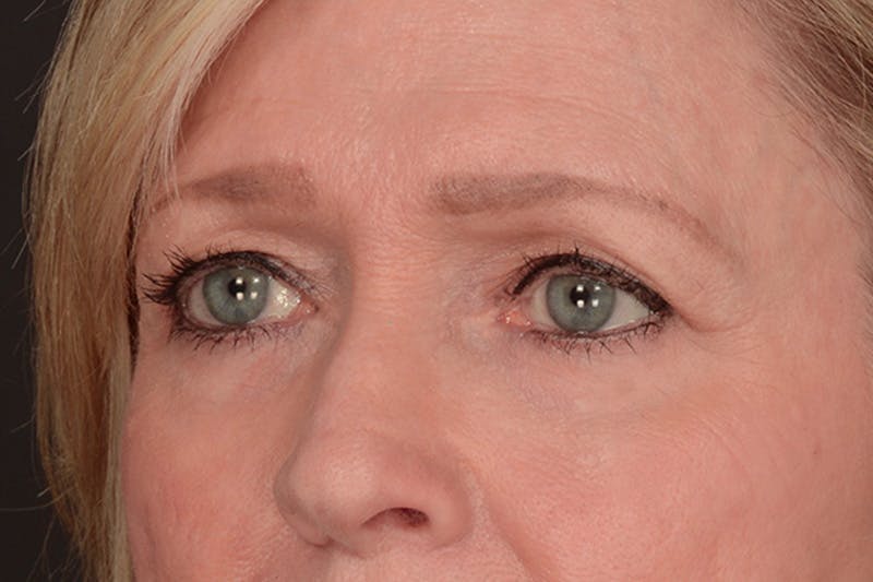Blepharoplasty Before & After Gallery - Patient 151987 - Image 9