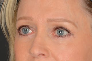 Blepharoplasty Before & After Gallery - Patient 102153 - Image 10