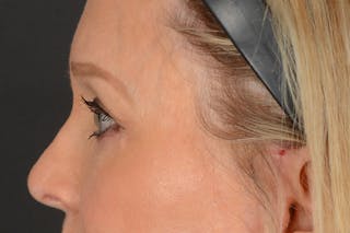 Blepharoplasty Before & After Gallery - Patient 102153 - Image 12