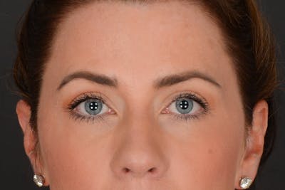 Blepharoplasty Before & After Gallery - Patient 126508 - Image 2