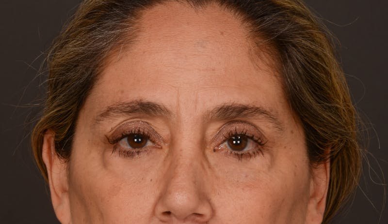 Blepharoplasty Before & After Gallery - Patient 147452 - Image 1