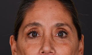 Blepharoplasty Before & After Gallery - Patient 147452 - Image 2
