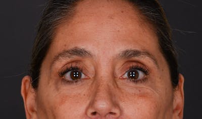 Blepharoplasty Before & After Gallery - Patient 147452 - Image 2