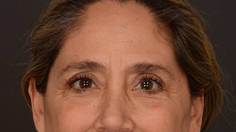 Blepharoplasty Before & After Gallery - Patient 147452 - Image 3