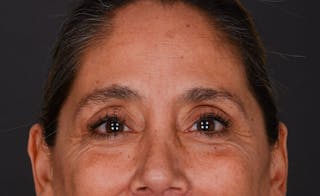Blepharoplasty Before & After Gallery - Patient 147452 - Image 4