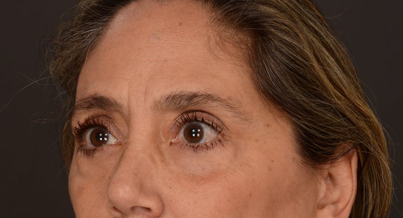 Blepharoplasty Before & After Gallery - Patient 147452 - Image 5