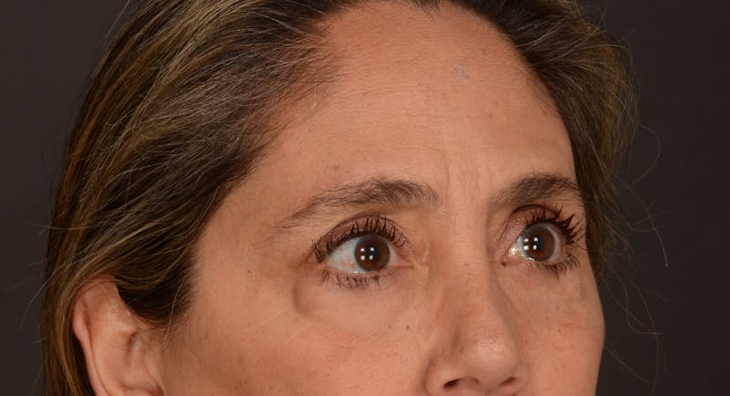 Blepharoplasty Before & After Gallery - Patient 147452 - Image 7