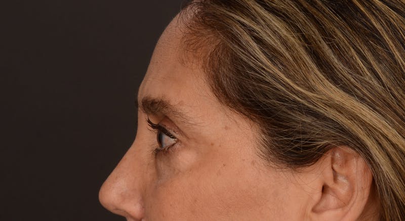 Blepharoplasty Before & After Gallery - Patient 147452 - Image 9
