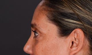 Blepharoplasty Before & After Gallery - Patient 147452 - Image 10