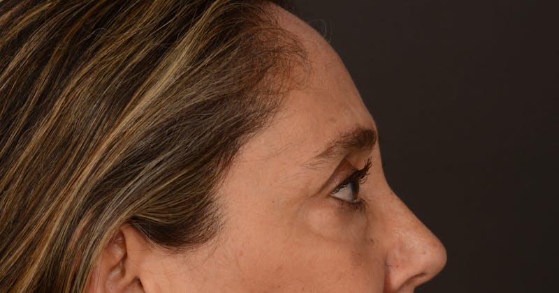 Blepharoplasty Before & After Gallery - Patient 147452 - Image 11