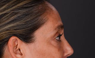 Blepharoplasty Before & After Gallery - Patient 147452 - Image 12