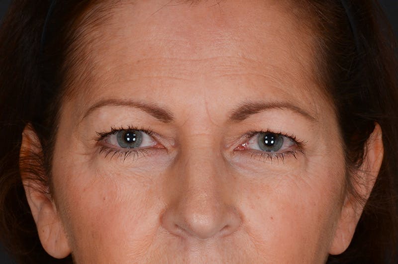 Blepharoplasty Before & After Gallery - Patient 326516 - Image 1