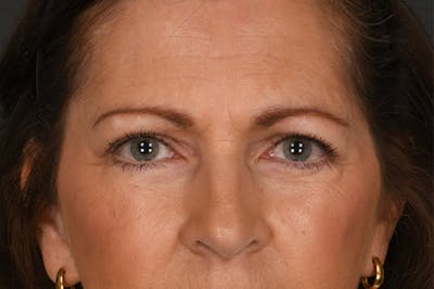 Blepharoplasty Before & After Gallery - Patient 326516 - Image 2
