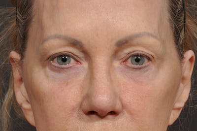 Blepharoplasty Before & After Gallery - Patient 535131 - Image 1