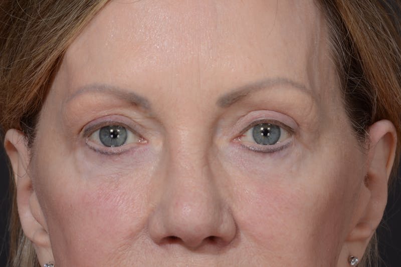 Blepharoplasty Before & After Gallery - Patient 535131 - Image 2