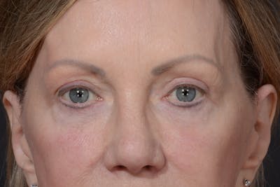 Blepharoplasty Before & After Gallery - Patient 535131 - Image 2
