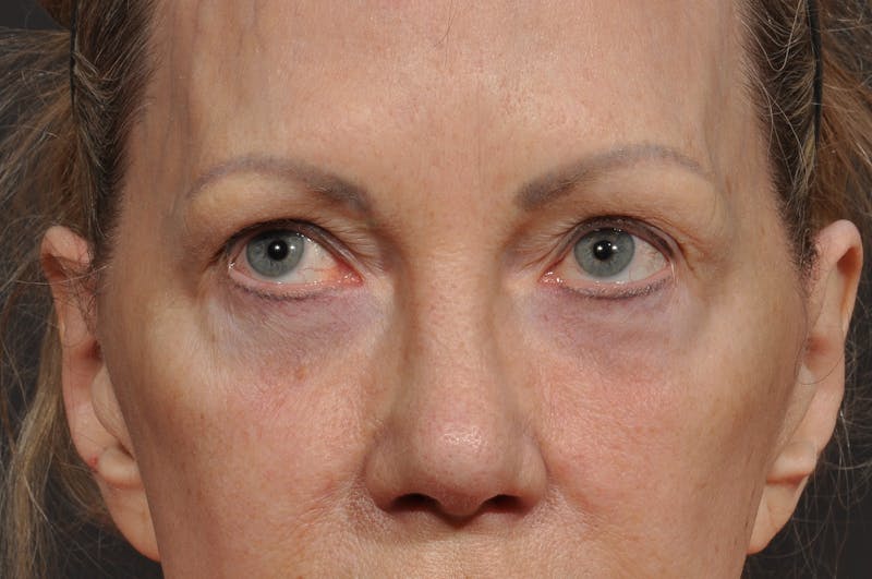 Blepharoplasty Before & After Gallery - Patient 535131 - Image 3