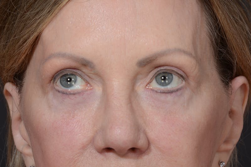 Blepharoplasty Before & After Gallery - Patient 535131 - Image 4