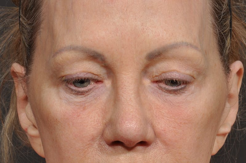 Blepharoplasty Before & After Gallery - Patient 535131 - Image 5