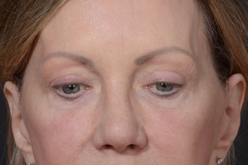 Blepharoplasty Before & After Gallery - Patient 535131 - Image 6