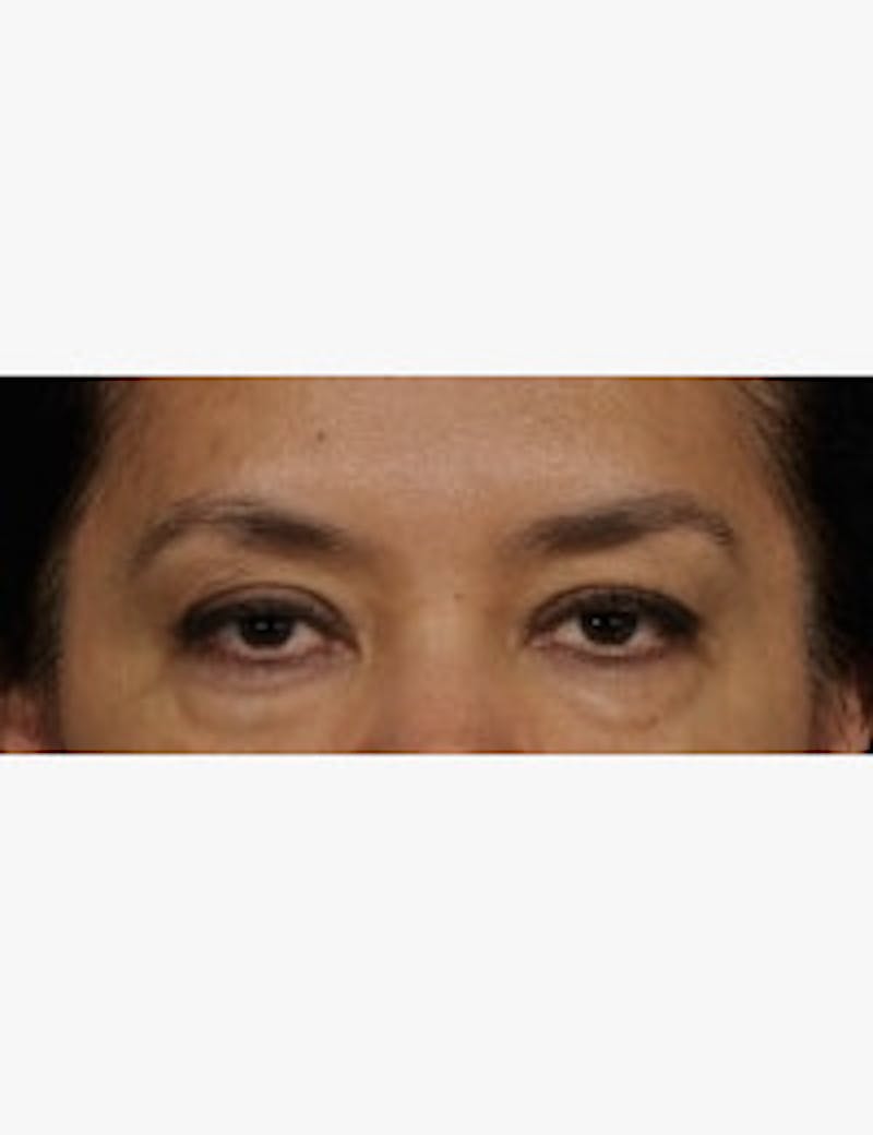 Blepharoplasty Before & After Gallery - Patient 301318 - Image 1