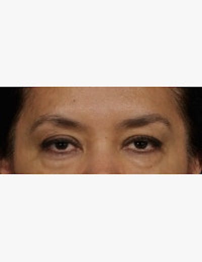 Blepharoplasty Before & After Gallery - Patient 301318 - Image 1