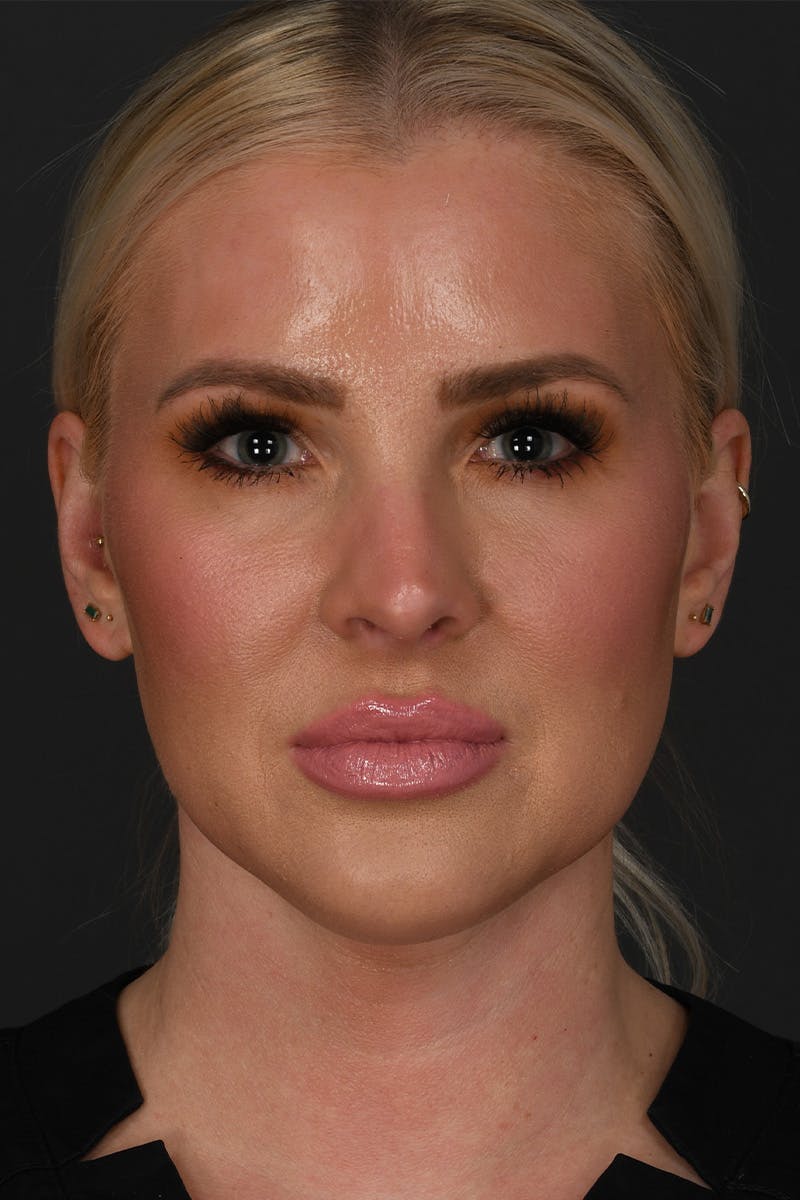 Submental Liposuction Before & After Gallery - Patient 468356 - Image 1