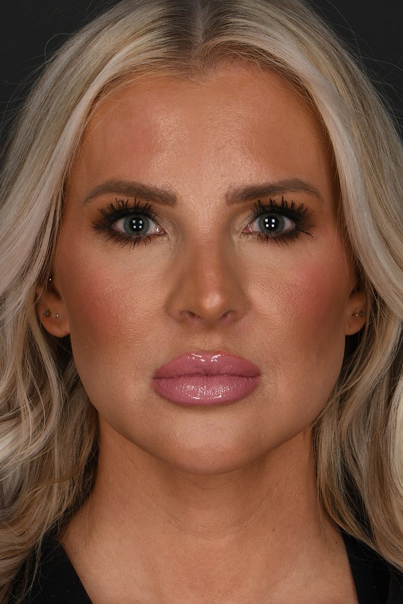 Submental Liposuction Before & After Gallery - Patient 468356 - Image 2