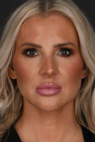 Submental Liposuction Before & After Gallery - Patient 468356 - Image 2