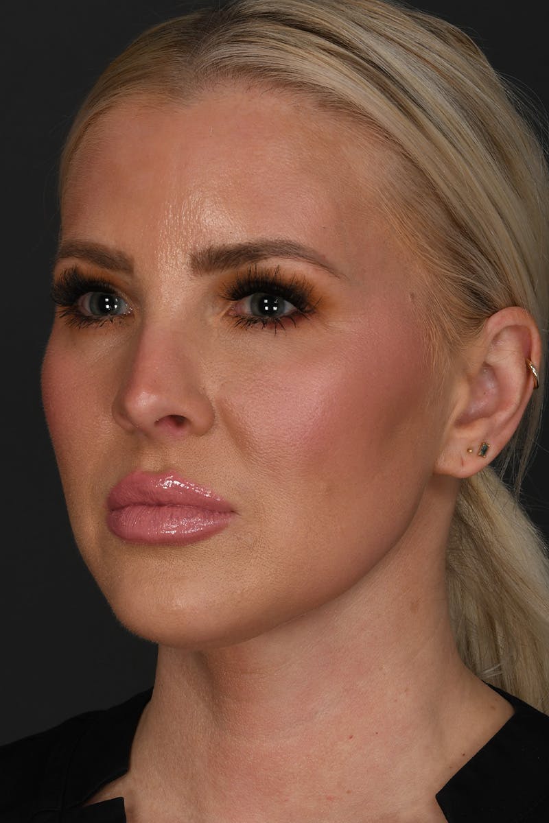 Submental Liposuction Before & After Gallery - Patient 468356 - Image 3