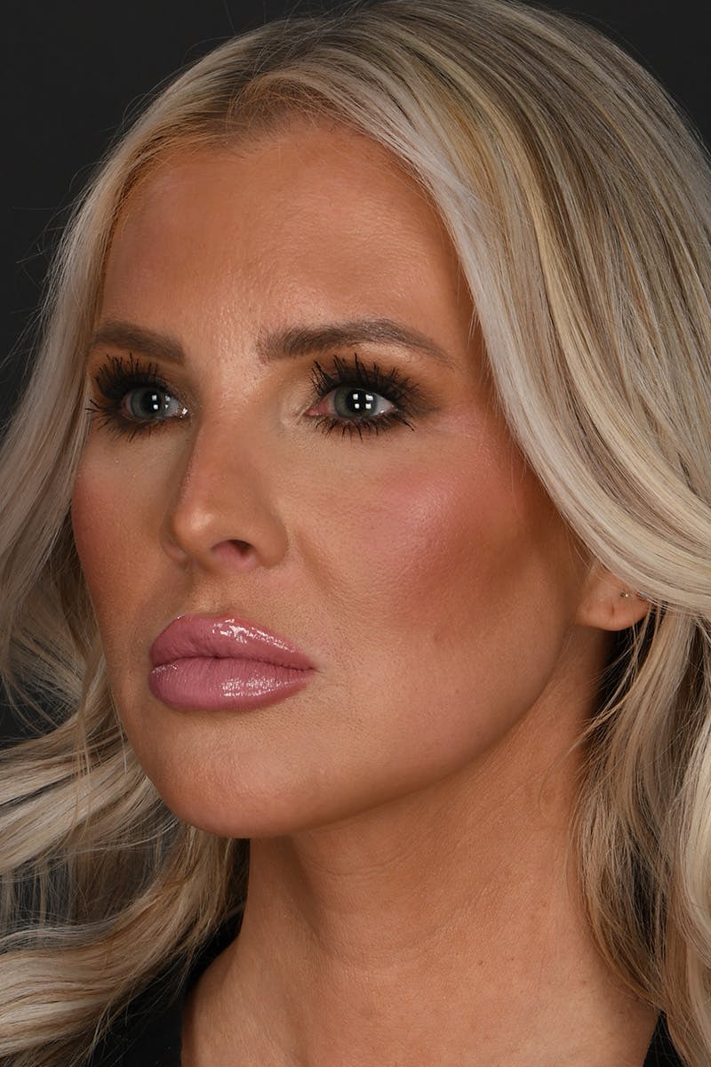 Submental Liposuction Before & After Gallery - Patient 468356 - Image 4