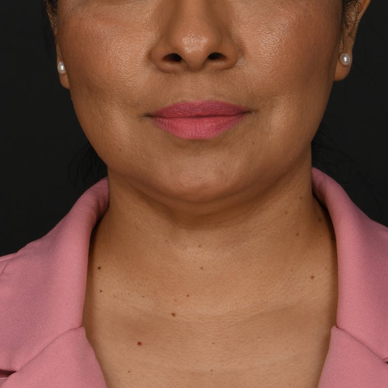 Buccal Fat Removal Before & After Gallery - Patient 363384 - Image 1