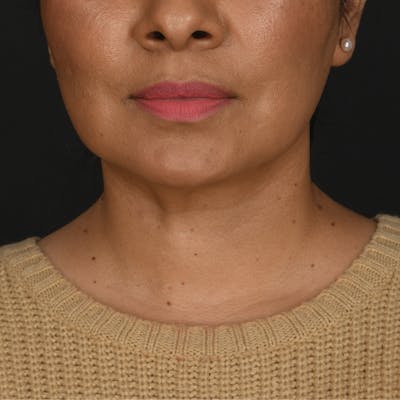 Submental Liposuction Before & After Gallery - Patient 326629 - Image 2